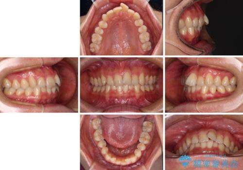 手間をかけずに治したい 短期間のワイヤー矯正の治療前