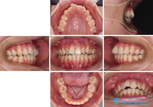 【モニター】舌のトレーニングを行いながら後戻りの再矯正の治療前