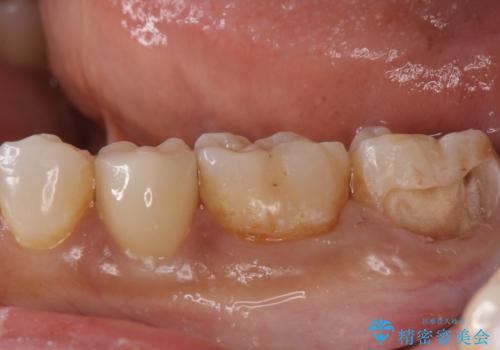 産後の虫歯治療 セラミッククラウンでの治療の治療中