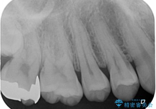 銀歯をなくしたい ジルコニアクラウンでの修復の治療前