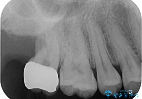 銀歯をなくしたい ジルコニアクラウンでの修復の治療後