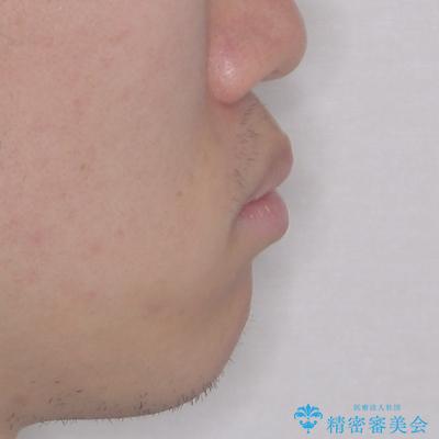 出っ歯と八重歯 目立たない裏側装置でスッキリとした口元にの治療前(顔貌)