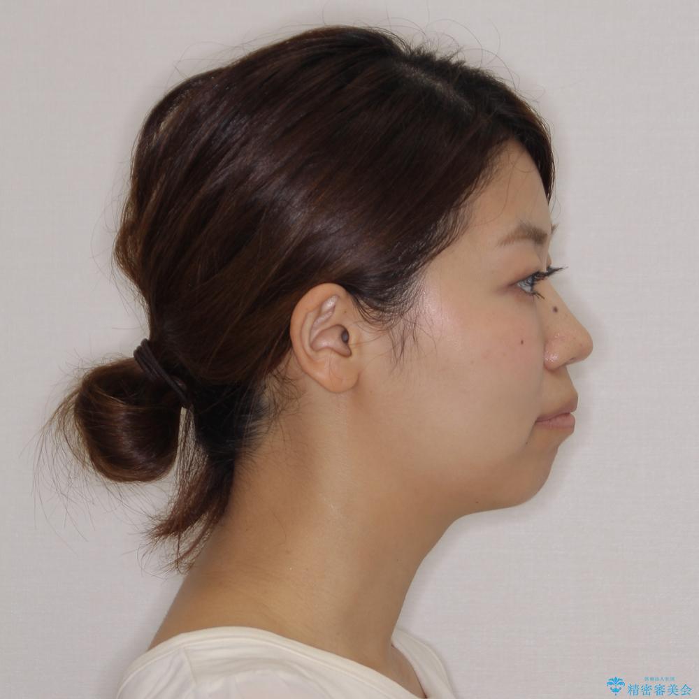 【モニター】横顔のシルエットをスッキリと　ワイヤー装置による抜歯矯正治療の治療前（顔貌）