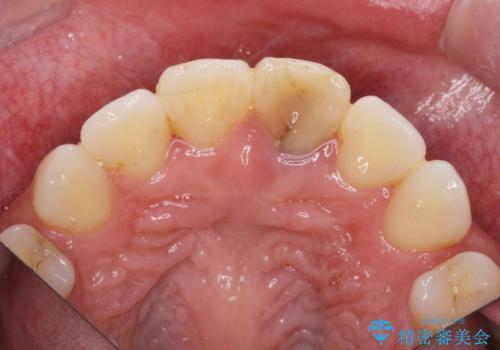 変色してきた前歯をセラミック治療の治療前