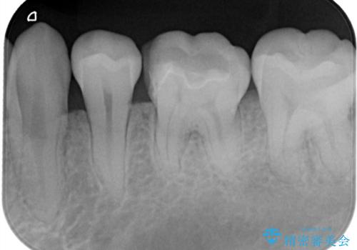 【ハイブリッドインレー】銀歯を白くしたい!の治療後