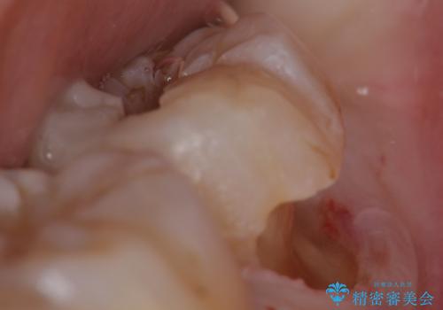産後の虫歯治療 セラミッククラウンでの治療の治療後