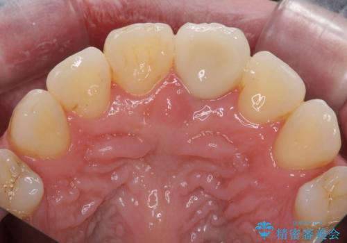 変色してきた前歯をセラミック治療の治療後