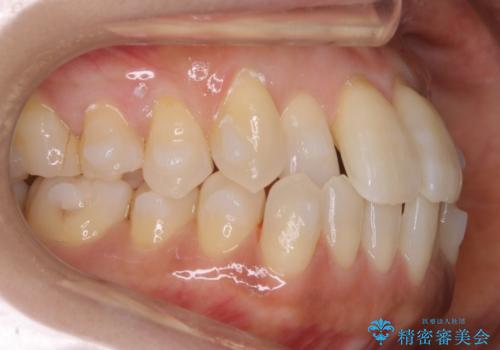 【非抜歯】短期間で実現する前歯の反対咬合治療の治療中
