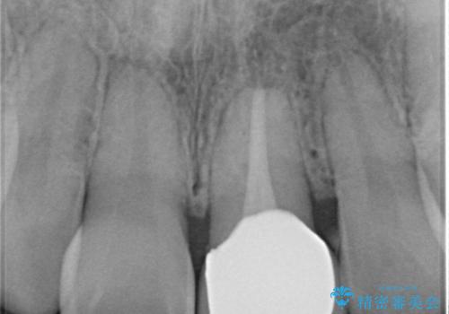 変色してきた前歯をセラミック治療の治療後