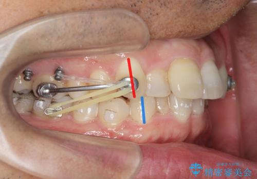 2級ディープバイト 遠心移動を伴うマウスピース矯正