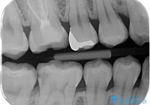 見た目にはわかりにくい奥歯の虫歯　セラミックインレーでの治療の治療前