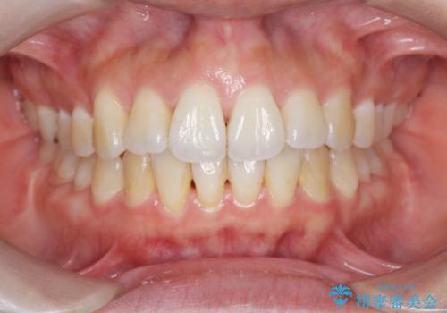 [ マウスピース矯正 ]  出っ歯に見える前歯を改善したいの症例 治療後