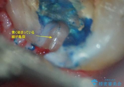 【インプラント】食事中に歯が割れた! かなり深いところまで歯が割れていたの治療中
