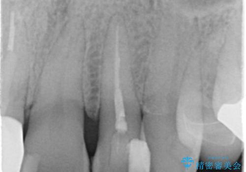 前歯を綺麗にしたい。 ジルコニアクラウンでの修復の治療前