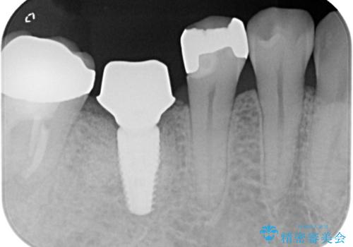 【インプラント】食事中に歯が割れた! かなり深いところまで歯が割れていたの治療中