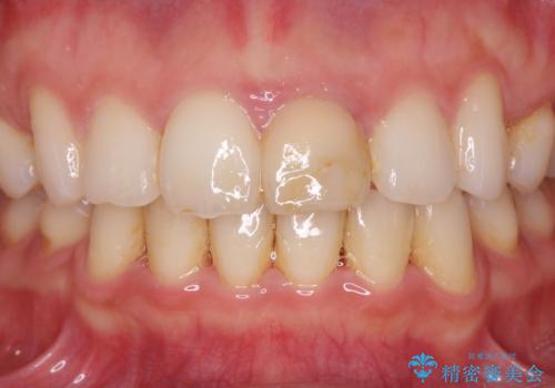 変色してきた前歯をセラミック治療の治療前