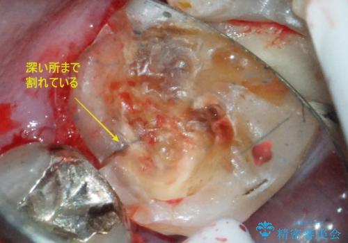 【インプラント】食事中に歯が割れた! かなり深いところまで歯が割れていたの治療中