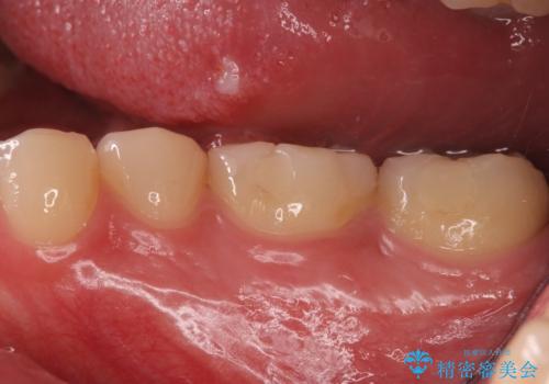 奥歯がしみる 神経を温存する治療の治療前