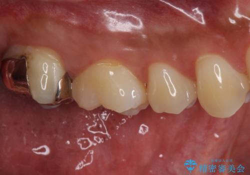 銀歯をなくしたい ジルコニアクラウンでの修復の治療前