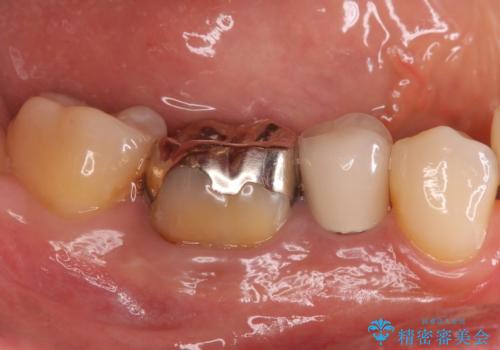 目立つ銀歯を白くしたい ジルコニアクラウンでの修復の治療前