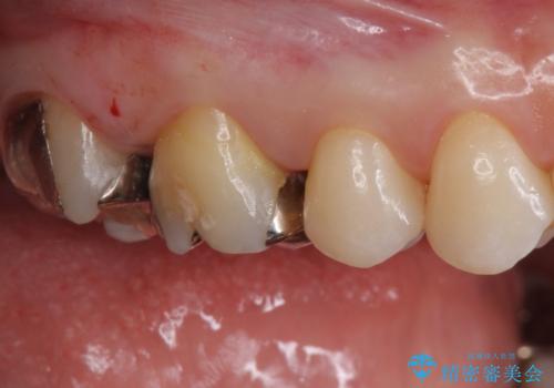 銀歯を白くしたいの治療前