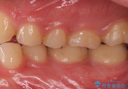 奥歯がしみる 神経を温存する治療の治療前