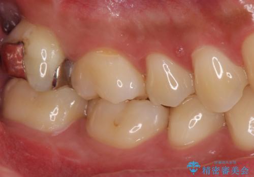 銀歯をなくしたい ジルコニアクラウンでの修復の治療前