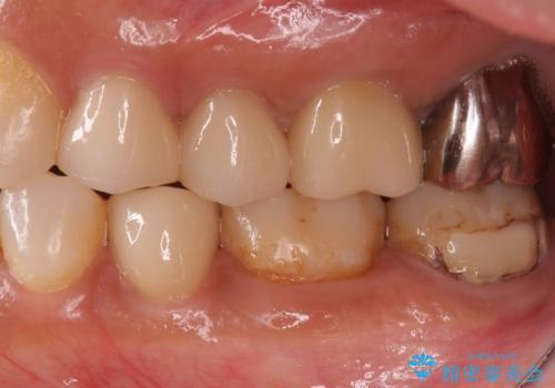 産後の虫歯治療 セラミッククラウンでの治療の治療前