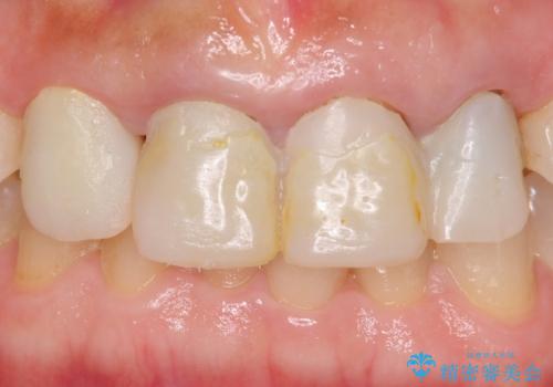 自然な前歯にしたい ジルコニアクラウンでの修復の治療前
