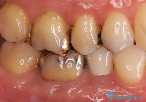 目立つ銀歯を白くしたい ジルコニアクラウンでの修復の治療前