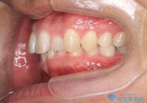 2級ディープバイト 遠心移動を伴うマウスピース矯正の治療前