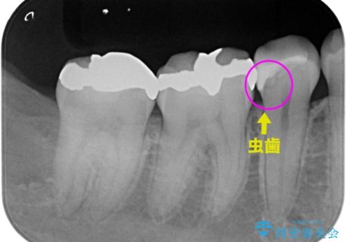 レントゲンで見つかった歯と歯の間の虫歯をセラミックインレーで修復の治療中