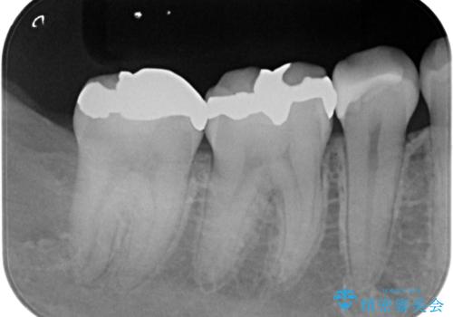 レントゲンで見つかった歯と歯の間の虫歯をセラミックインレーで修復の治療前
