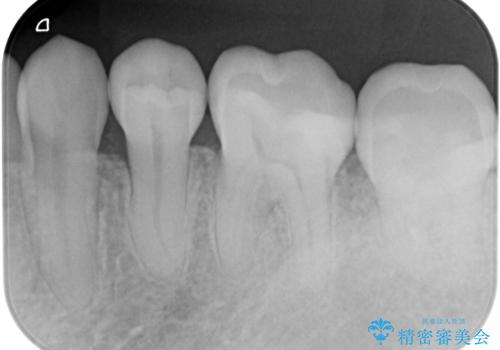 メタルの詰め物が取れたの治療後