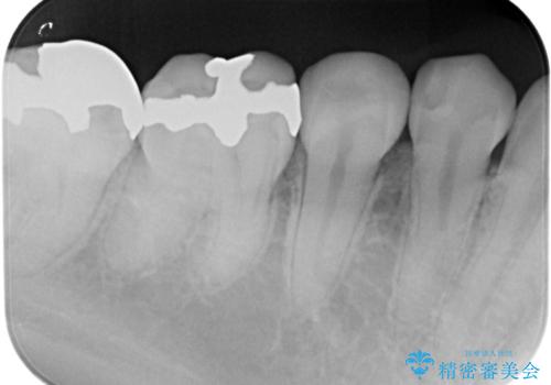 レントゲンで見つかった歯と歯の間の虫歯をセラミックインレーで修復の治療後