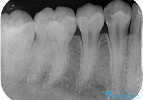 奥歯のむし歯治療 セラミックインレーの治療前