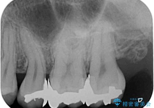 奥歯のむし歯治療 セラミックインレーの治療前
