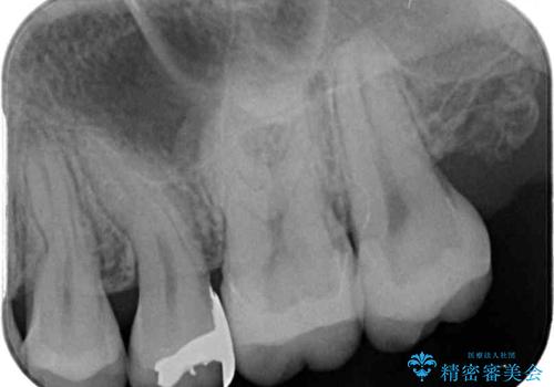 奥歯のむし歯治療 セラミックインレーの治療後