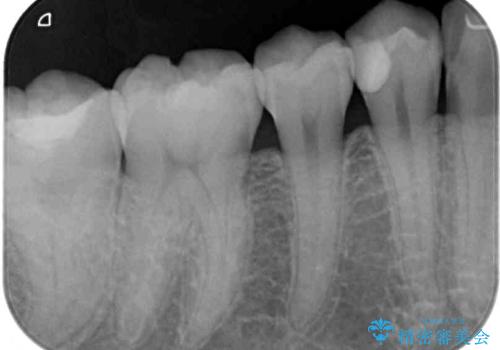 奥歯のむし歯治療 セラミックインレーの治療後