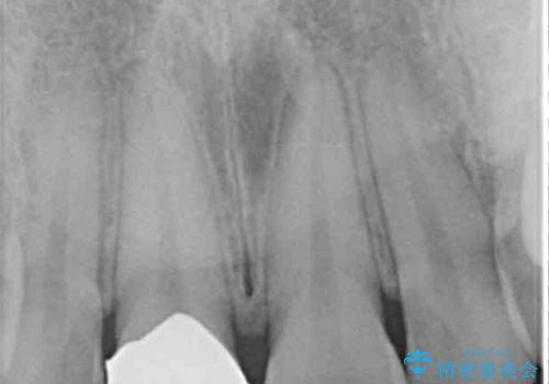 適合の悪い保険診療のクラウンをオールセラミッククラウンにの治療前
