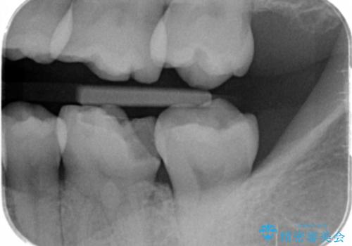 メタルの詰め物が取れたの治療前