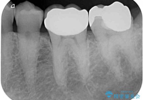 欠けてしまった奥歯のむし歯治療の治療後