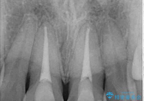 変色した前歯 オールセラミッククラウンにより審美歯科治療の治療前