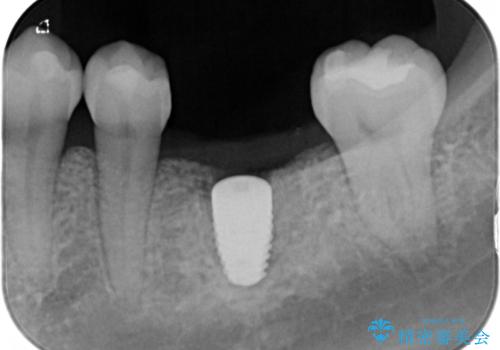 【抜歯】矯正治療とインプラントで正常な噛み合わせを実現の治療後