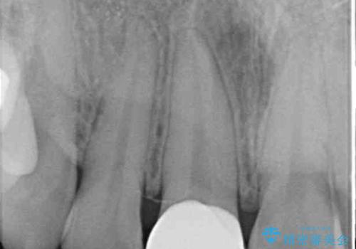 適合の悪い保険診療のクラウンをオールセラミッククラウンにの治療後