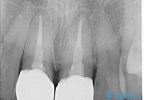 変色した前歯 オールセラミッククラウンにより審美歯科治療の治療後