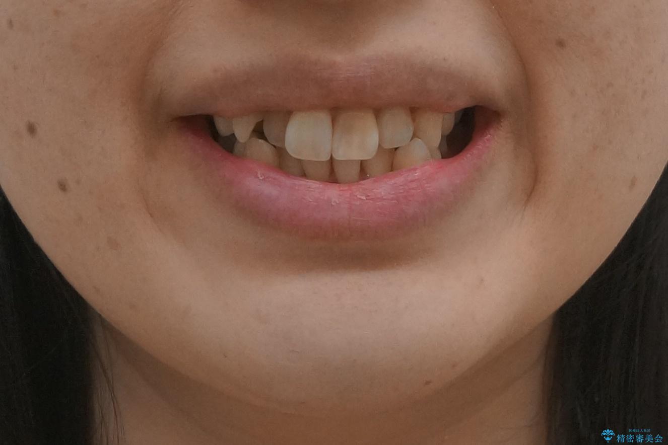 歯のがたつき 4本抜歯を回避してマウスピース矯正への治療前(顔貌)