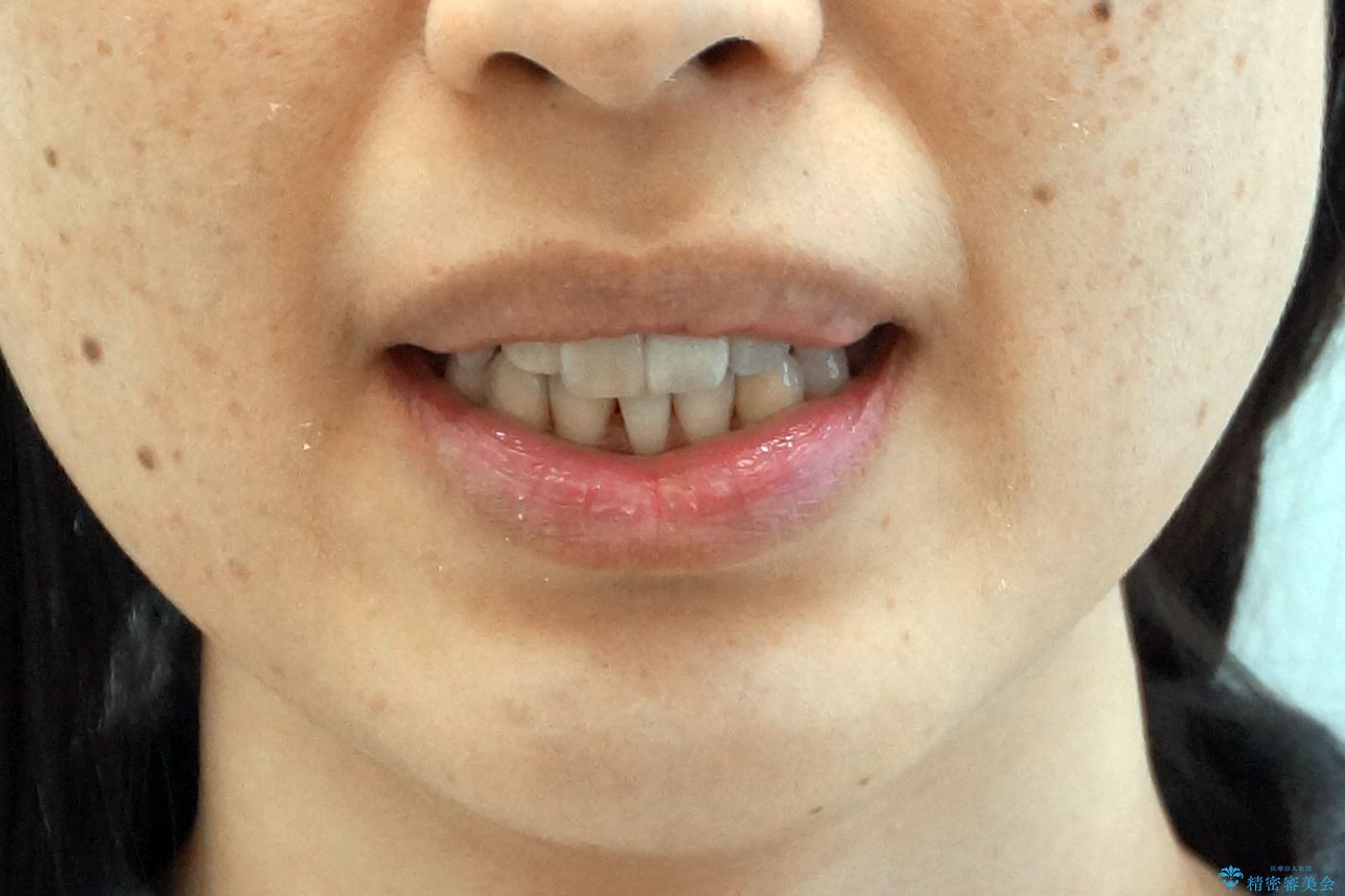 歯のがたつき 4本抜歯を回避してマウスピース矯正への治療後(顔貌)