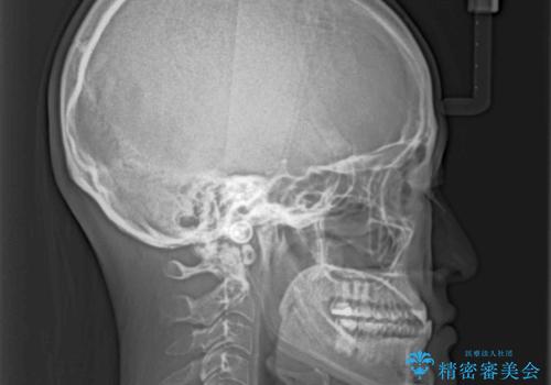 前歯のクロスバイトを治したい ワイヤー装置による矯正治療の治療前