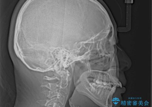 八重歯と乱れた咬み合わせを改善 ワイヤー装置での抜歯矯正の治療前